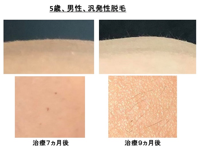 汎発性脱毛　病院